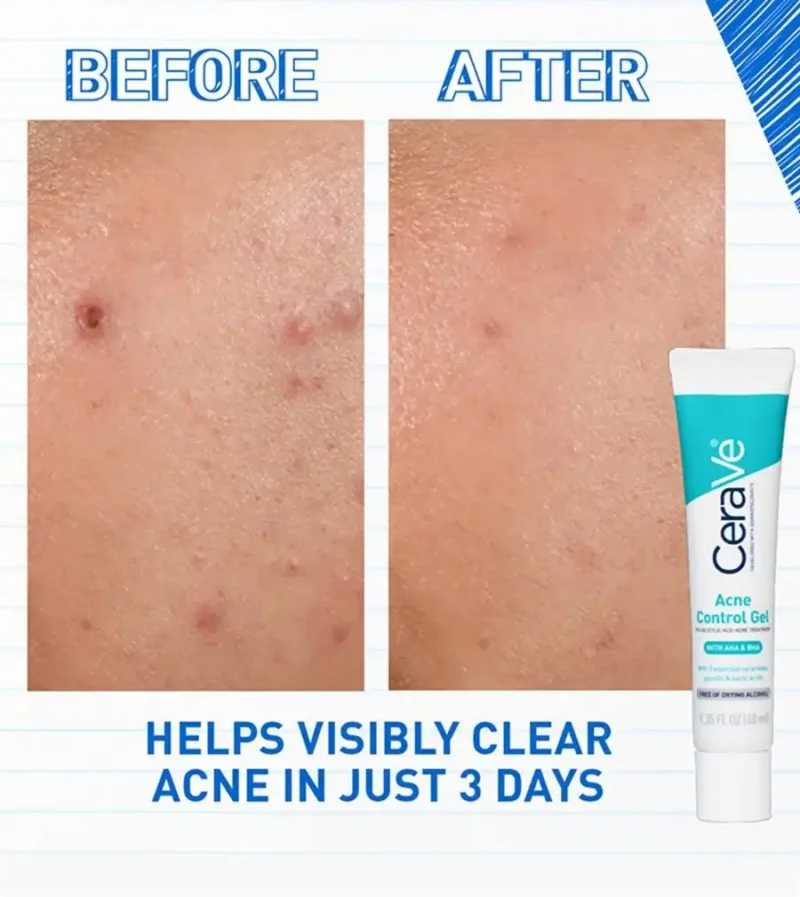 cerave-blemish-control-gel-40ml
